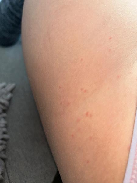 Červené pupínky po těle. Co by to mohlo být?