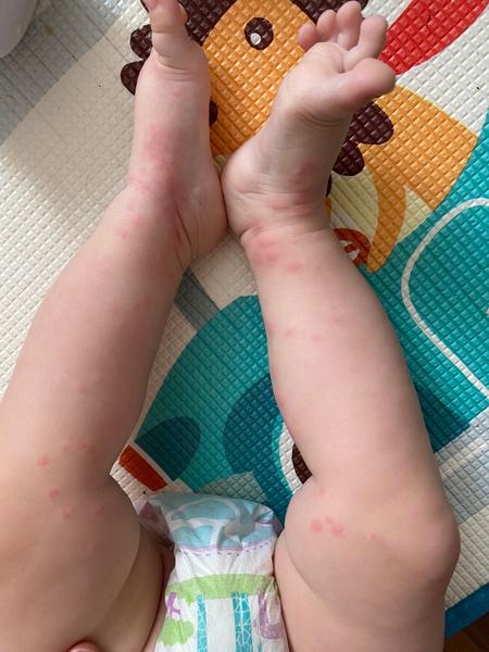 Vyrážka. Co myslíte?