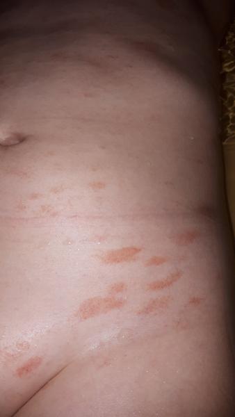 Ekzém (kvasinka) nebo alergie?