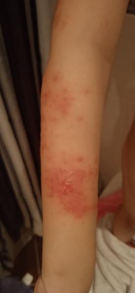 Ekzém nebo kvasinka?