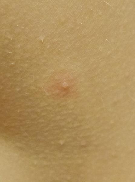 Jsou pupínky na těle příznakem neštovic?