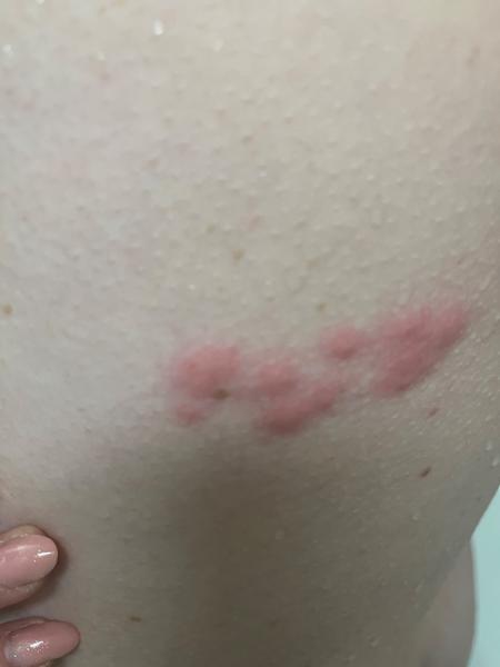 Může být pásový opar bez bolesti a svědění?