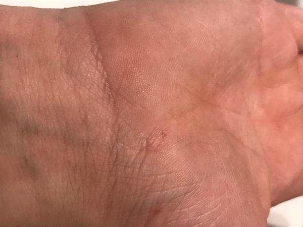 Svědivá kožní vyrážka: Co může být příčinou?