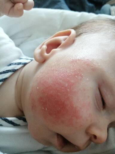 Kvasinka nebo atopický ekzém? Jak léčit?