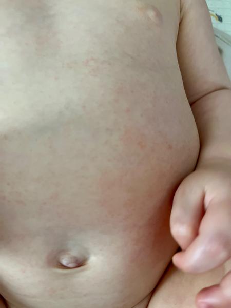 Suchá vyrážka u dětí. Co ji může způsobit?