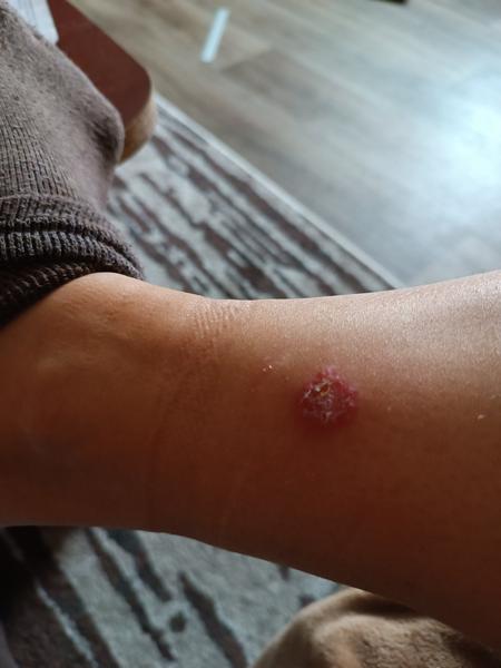 Je to streptokok nebo zlatý stafylokok? Odborná pomoc na fóru.