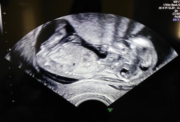 Pohlaví miminka. Zkusíte tipnout?