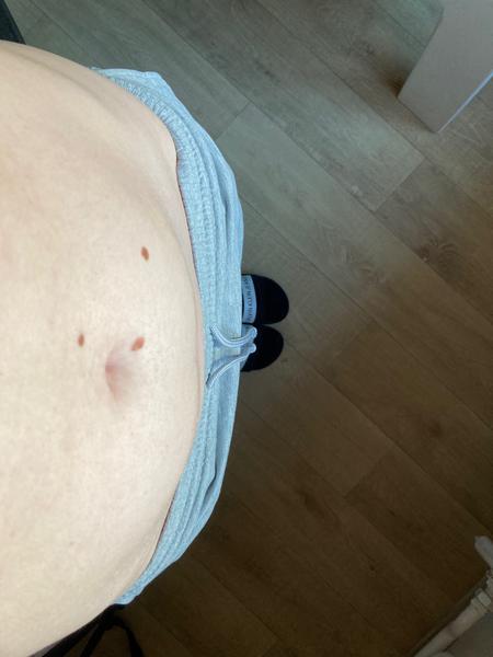 Vypouklý podbřišek a nepravidelná menstruace: Je to rakovina?