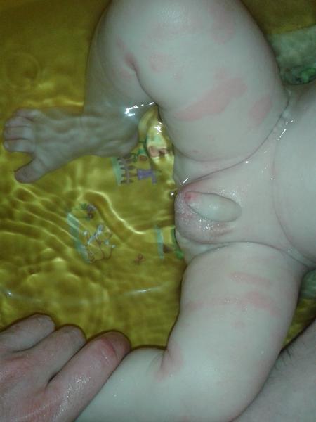 Červené fleky na nohách, co by pomohlo?