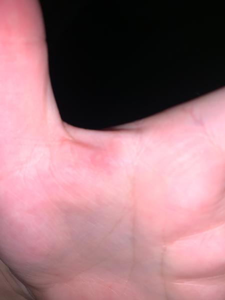 Jak rozpoznat svrab: zkušenosti a rady pro rodiny?