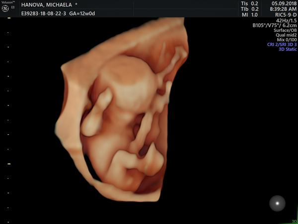 Pohlaví miminka - může to být kluk?