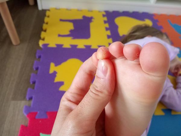 Deformace prstu. Jak se řeší?