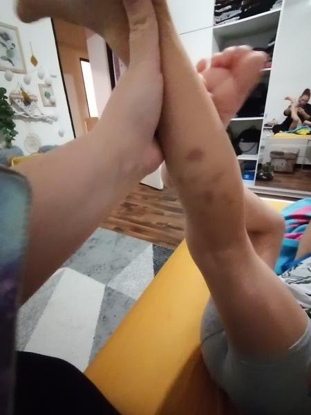 Je normální, když se objevují modřiny na nohách u dětí?