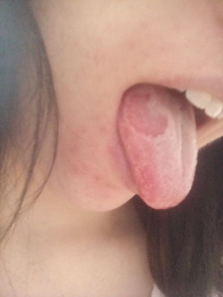 Červený hladký flek na jazyku v těhotenství