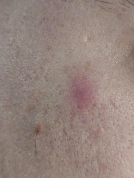 Vyrážka na tváři. Může to být vnitřní pupínek?