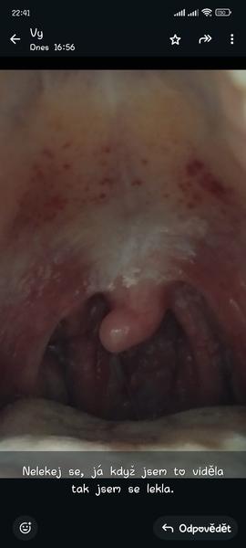 Bolest v krku při polykání. Jaké jsou možné příčiny?