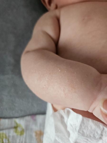 Suchá kůže, ekzém nebo kvasinka?