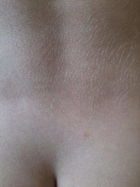 Jsou to opravdu neštovice? Zjistěte, jak je poznat!