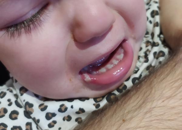 Rozkouslý ret u dítěte. Kdy navštívit lékaře?