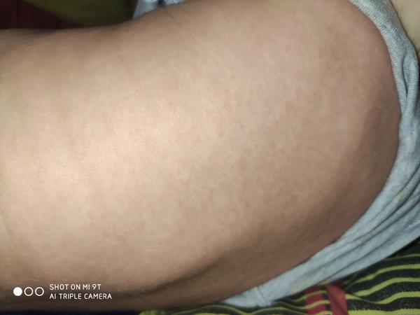 Šestá nemoc nebo spalničky - bojím se. Já měly Vaše děti vyrážky?