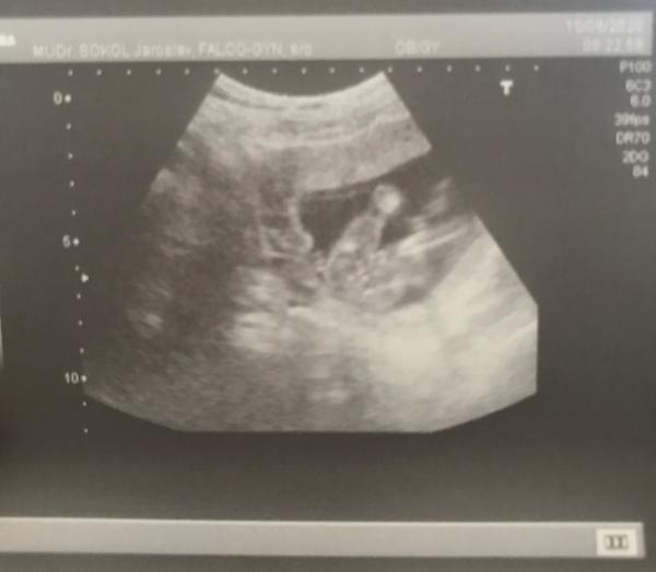 Chlapeček nebo holčička. Foto ultrazvuku. Co myslíte Vy?