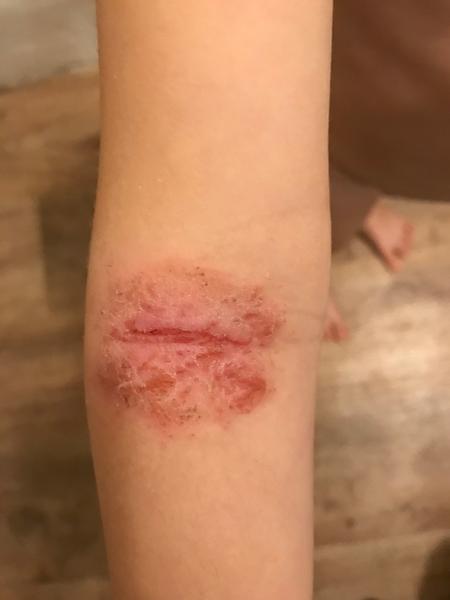 Ekzém, dcerka 3,5 roku. Je kvasinkový?