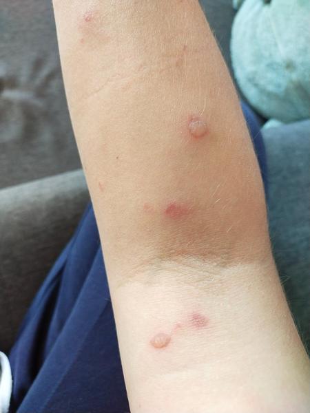 Co způsobuje puchýře na ruce? Zkušenosti a rady.