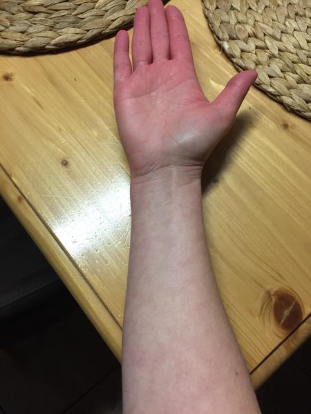 Fleky po celém těle. Co by to mohlo být?