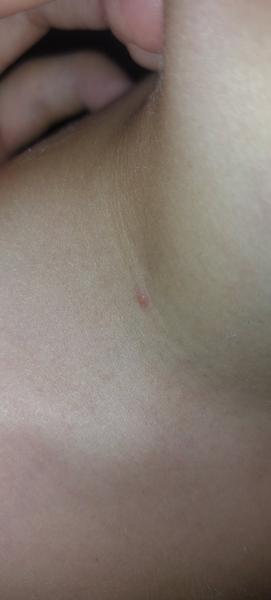 Může zvýraznění místa po klíštěti znamenat boreliózu?