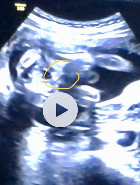 Poznáte z ultrazvuku pohlaví?