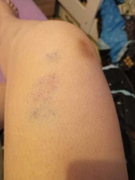 Flek na noze. Co to může znamenat?