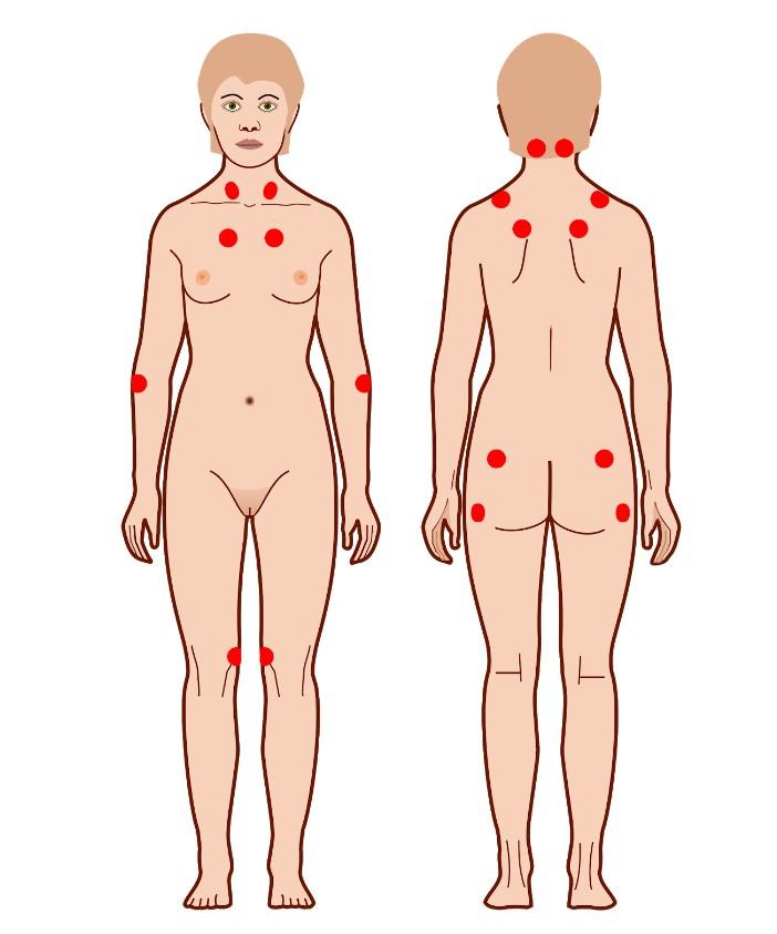 Ženské tělo a body, které mají fibromyalgici bolestivé