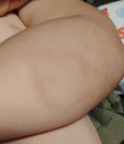 Červené fleky na těle. Máte zkušenost?