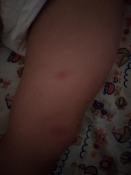 Prosím o radu. Mohou to být štípance?