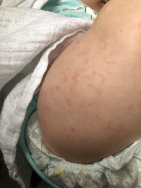 Fleky na těle u dítěte 5 let - jsou to potničky nebo něco jiného?