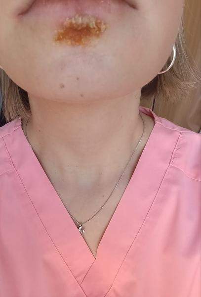 Jak odlišit opar od impetiga?