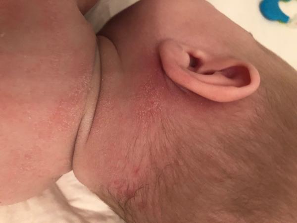 Ekzém nebo kvasinka. Jak a čím pokračovat v léčbě?