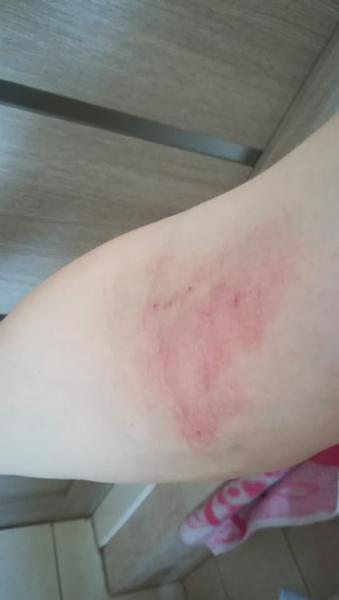 Ekzém. Jakou stravu omezit a čím natírat?