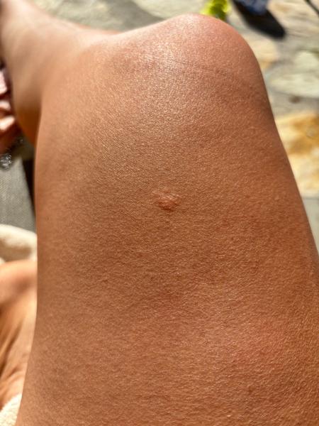 Co způsobuje svědivé vyrážky na těle? Zjistěte více!