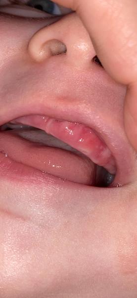 Je to afta nebo růst zoubků u dětí?