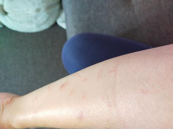 Co způsobuje puchýře na ruce? Zkušenosti a rady.