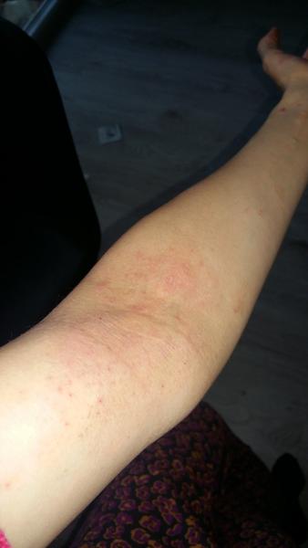 Ekzém po porodu. Může být způsoben kvasinkami?