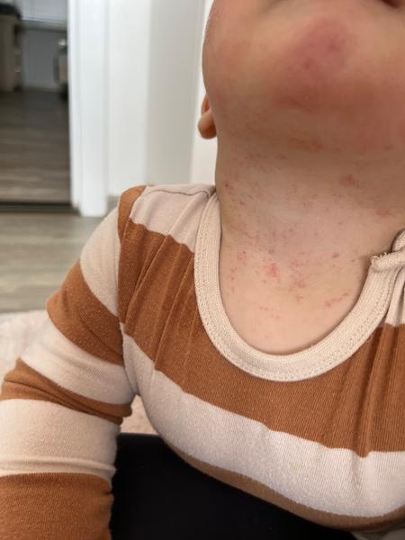 Co je to za vyrážku?