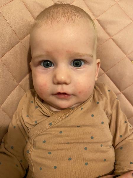 Je to alergie nebo ekzém?