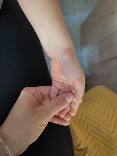 Jsou to neštovice? Jak poznat příznaky u dětí?