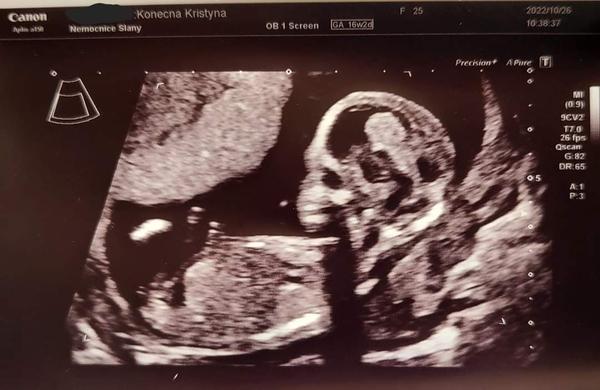 Jak odhadnout pohlaví miminka podle ultrazvuku?