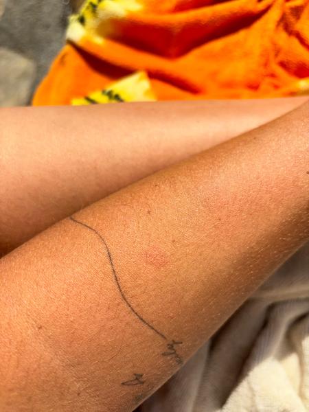 Co způsobuje svědivé vyrážky na těle? Zjistěte více!