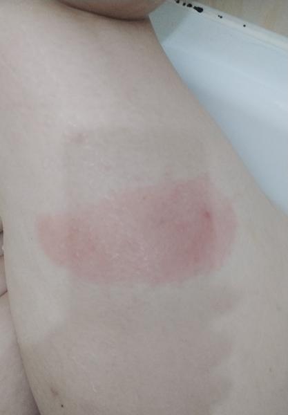 Flek po klíštěti při borelióze. Může svědit?