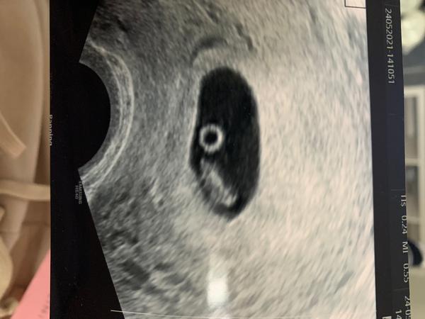 Co to je na ultrazvuku?