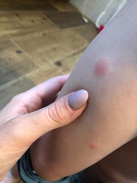 Fleky na kůži u dětí. Mohou to být neštovice?